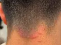 Irritación rojiza y escamosa en la nuca, sugiriendo la presencia de hongos en el cuello.