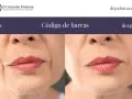 Antes y después de tratar el "código de barras" en los labios. Las arrugas verticales alrededor de la boca se suavizan.