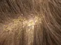 Primer plano del cuero cabelludo con caspa, mostrando escamas amarillentas y una postilla blanca entre el cabello castaño.