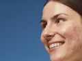 Mujer sonríe con granos entrecejo y mejillas. Piel con acné, fondo azul cielo.