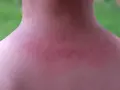 Piel enrojecida con pequeños bultos rojos en el cuello y hombros, indicativo de sarpullido por calor en adultos.