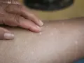 Una mano con un anillo toca la piel, revelando varias manchitas blancas en la piel, algunas más notorias que otras.
