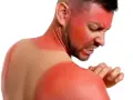 Hombre con quemaduras solares severas en cara y hombros. El vinagre para las quemaduras del sol podría aliviar su dolor.