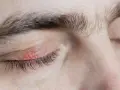 Párpado irritado con enrojecimiento y descamación, indicativo de dermatitis seborreica en las cejas y contorno del ojo.