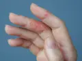 Mano con piel irritada y escamosa en los dedos, indicando picor en las manos.