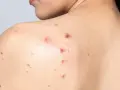 Granos por sudor en la espalda de una persona, algunos inflamados y rojos, otros más pequeños y secos.