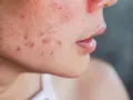 Primer plano de una mejilla con enrojecimiento y varias espinillas XXL infectadas, algunas con pus visible.