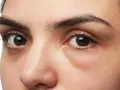 Ojos con ojeras marcadas y una leve hinchazón debajo, sugiriendo una cara hinchada tras una noche de poco descanso.