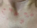 Manchas rojas en el cuello y pecho. ¿Cuándo preocuparse por manchas en la piel? Consulta a un médico si persisten o empeoran.
