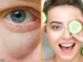 Ojo con bolsas y ojeras, comparado con una mujer sonriente usando rodajas de pepino, un remedio casero para las bolsas en los ojos.