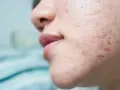 Primer plano de una mejilla con marcas de acné por estrés, mostrando rojeces e imperfecciones en la piel.