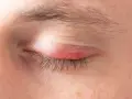 Un grano en la ceja que duele, inflamado y rojo, cerca de las pestañas.