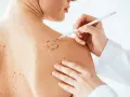 Médico marca con lápiz un lunar en la piel de un paciente. La piel tiene muchos lunares rojos y marrones.