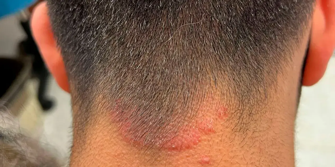 Irritación rojiza y escamosa en la nuca, sugiriendo la presencia de hongos en el cuello.