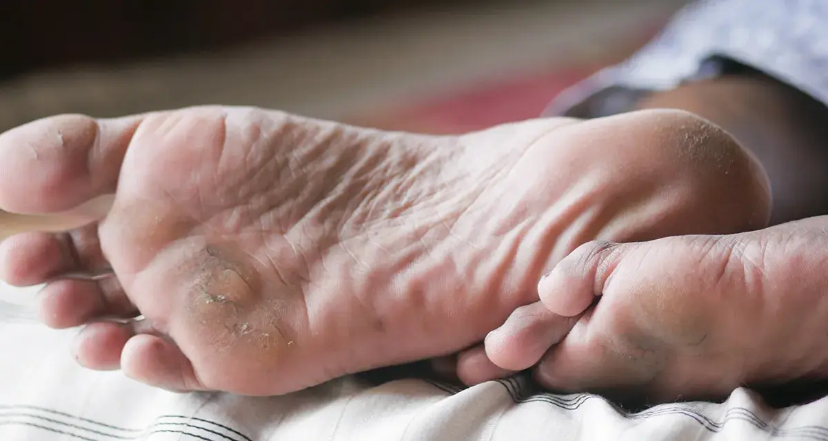 Pies secos y agrietados, con piel descamada. Si te preguntas qué hacer si se pelan los pies, esta imagen muestra la necesidad de hidratación y cuidado.