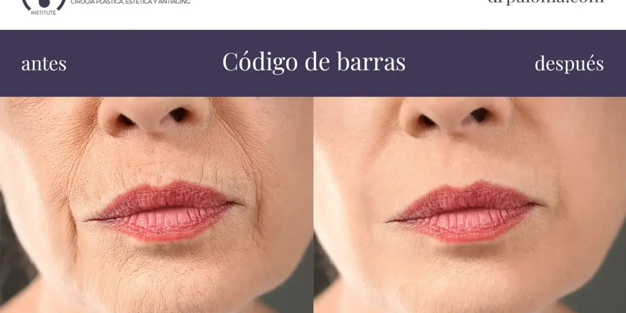 Antes y después de tratar el "código de barras" en los labios. Las arrugas verticales alrededor de la boca se suavizan.