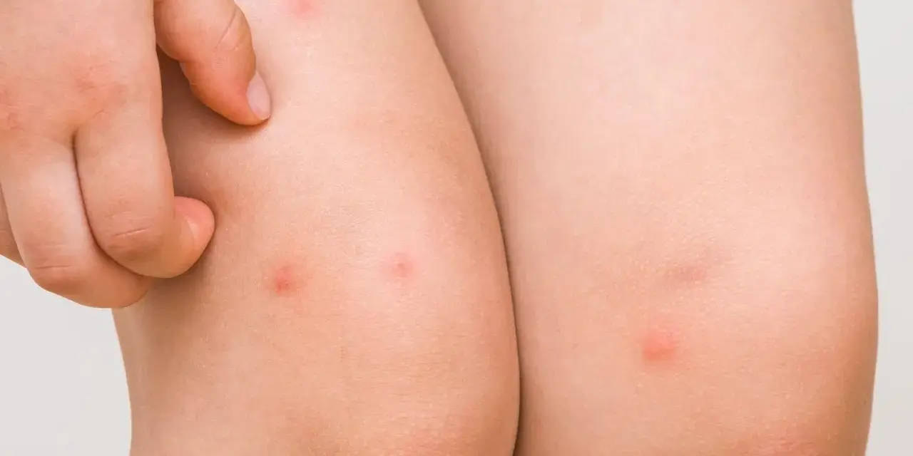 Piel con pequeños bultos rojos, indicativos de foliculitis en las piernas. Un dedo rasca la zona irritada.