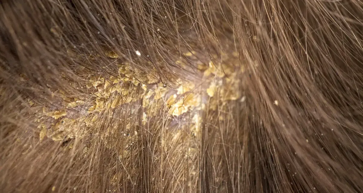 Primer plano del cuero cabelludo con caspa, mostrando escamas amarillentas y una postilla blanca entre el cabello castaño.