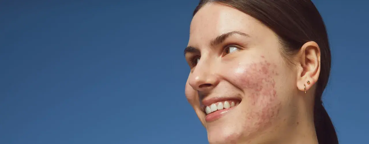 Mujer sonríe con granos entrecejo y mejillas. Piel con acné, fondo azul cielo.