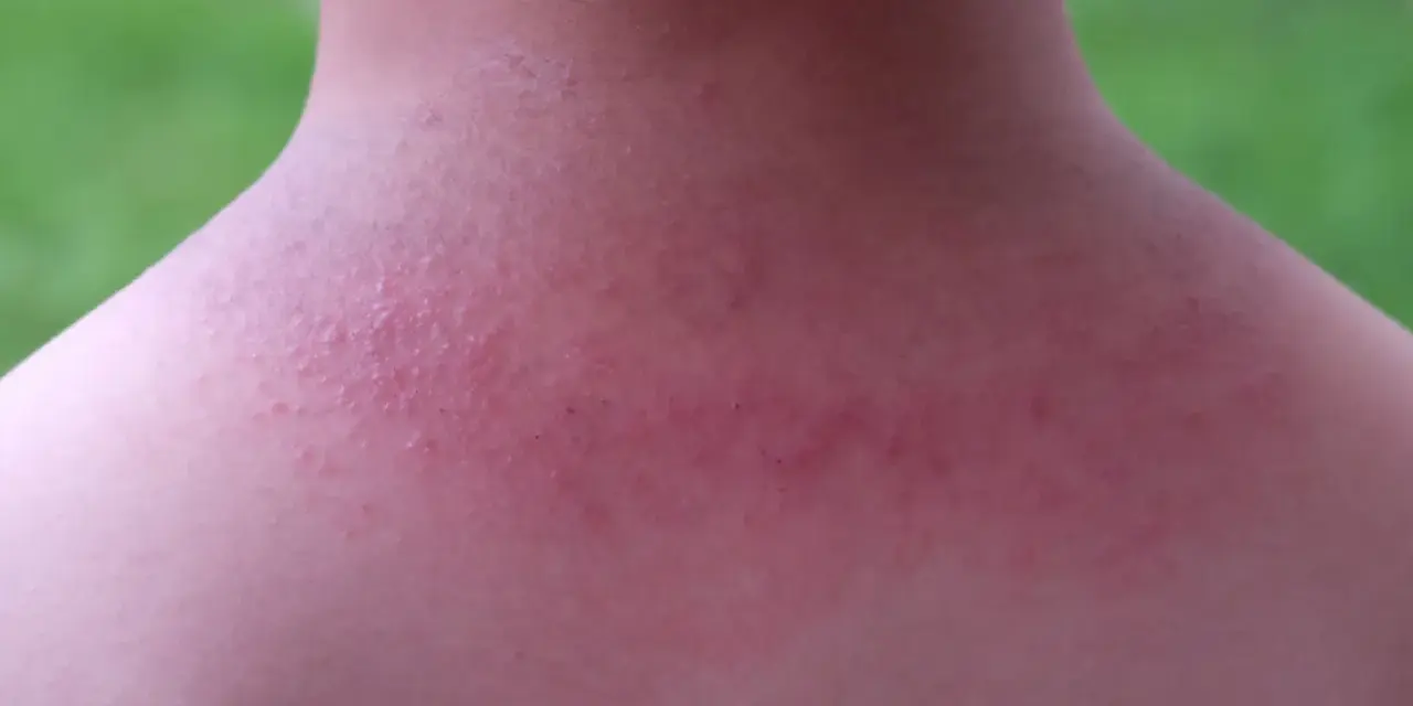 Piel enrojecida con pequeños bultos rojos en el cuello y hombros, indicativo de sarpullido por calor en adultos.