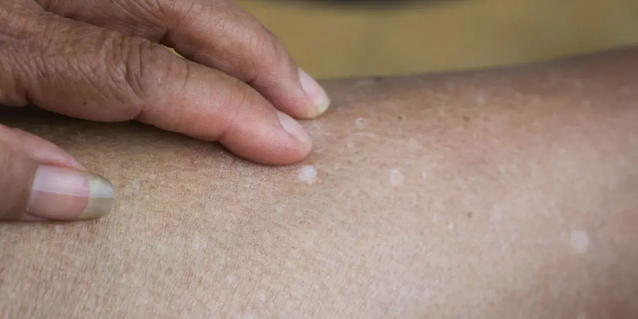 Una mano con un anillo toca la piel, revelando varias manchitas blancas en la piel, algunas más notorias que otras.