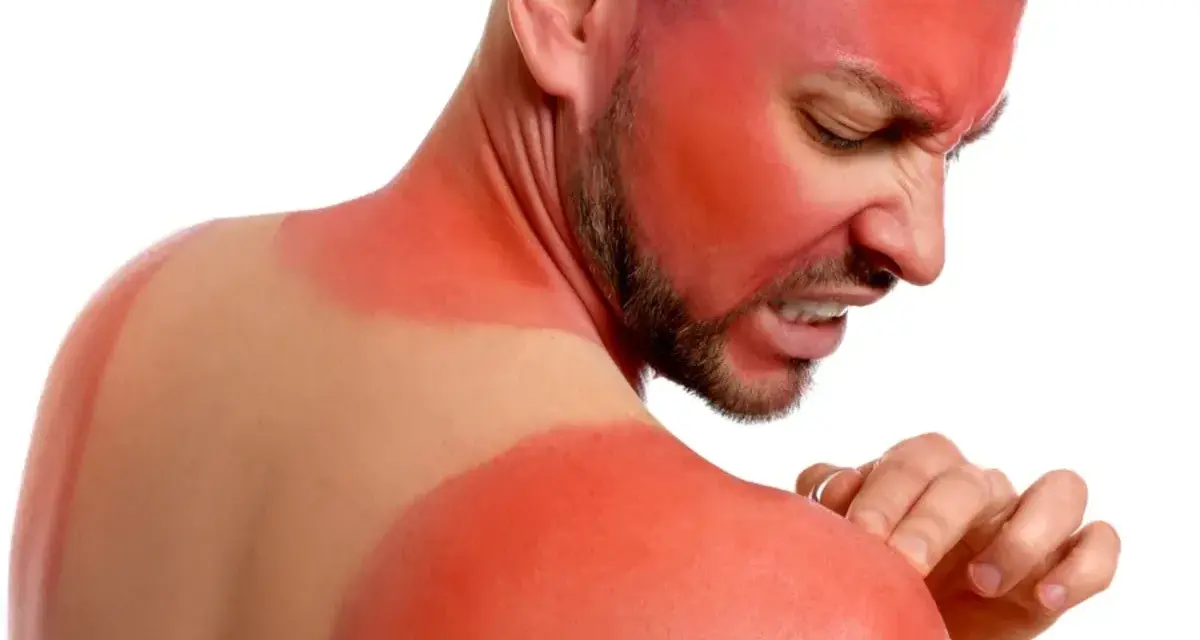 Hombre con quemaduras solares severas en cara y hombros. El vinagre para las quemaduras del sol podría aliviar su dolor.