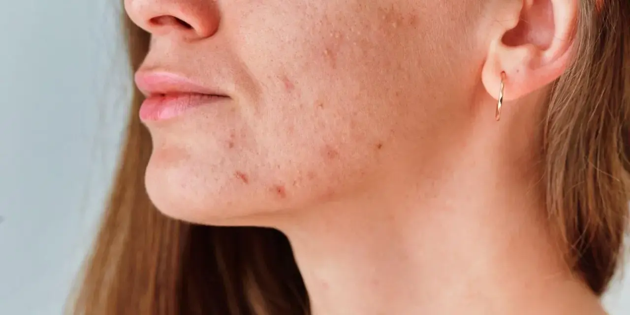 Primer plano de una mujer con marcas de acné en la mandíbula y el cuello.