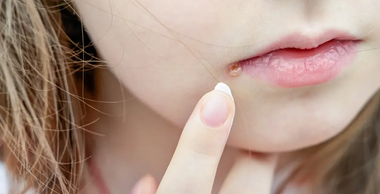 Dedo aplicando crema en granos en los labios.