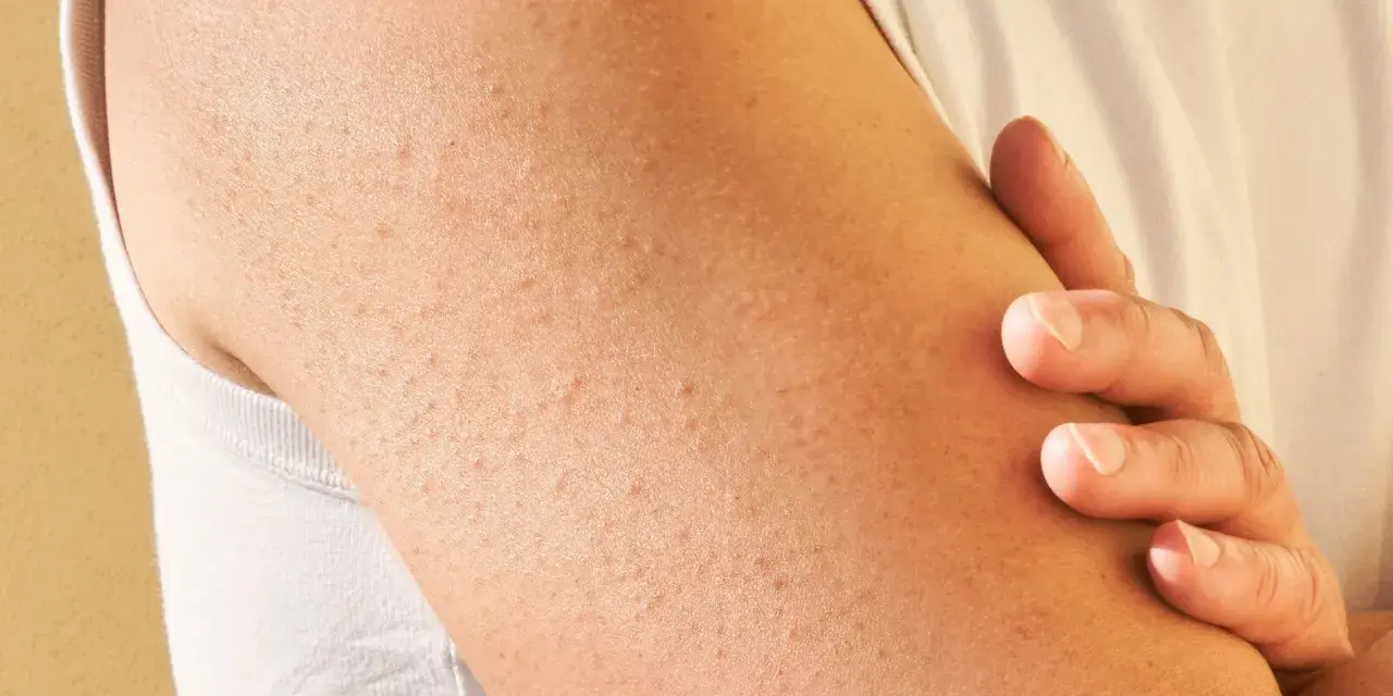 Brazo con pequeñas protuberancias rojas y blancas, indicativas de queratosis pilaris.