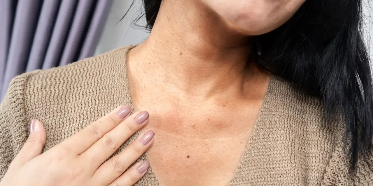 Una mujer se toca el cuello, mostrando pecas negras en la cara y el escote, con un suéter beige.