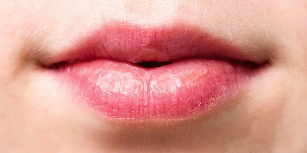 Labios rosados y agrietados, con signos de labios quemados por el sol.