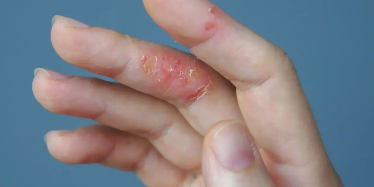 Mano con piel irritada y escamosa en los dedos, indicando picor en las manos.