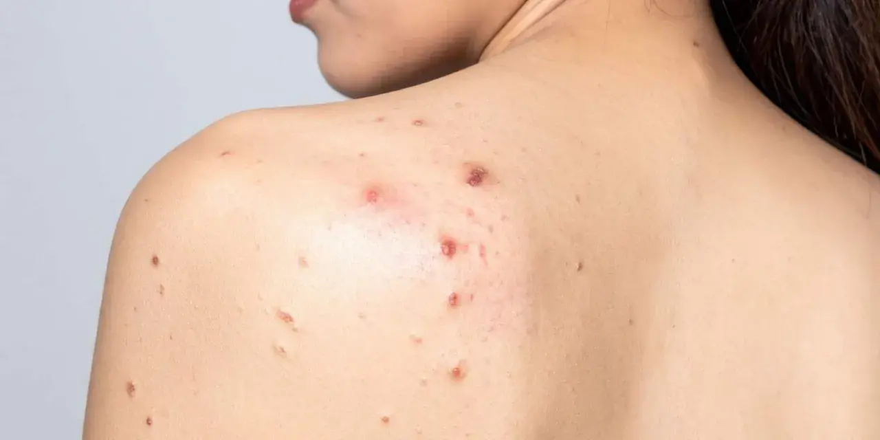 Granos por sudor en la espalda de una persona, algunos inflamados y rojos, otros más pequeños y secos.