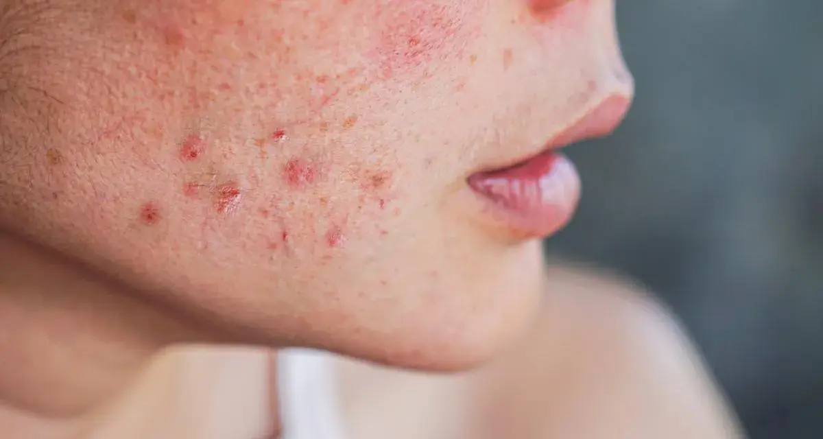 Primer plano de una mejilla con enrojecimiento y varias espinillas XXL infectadas, algunas con pus visible.