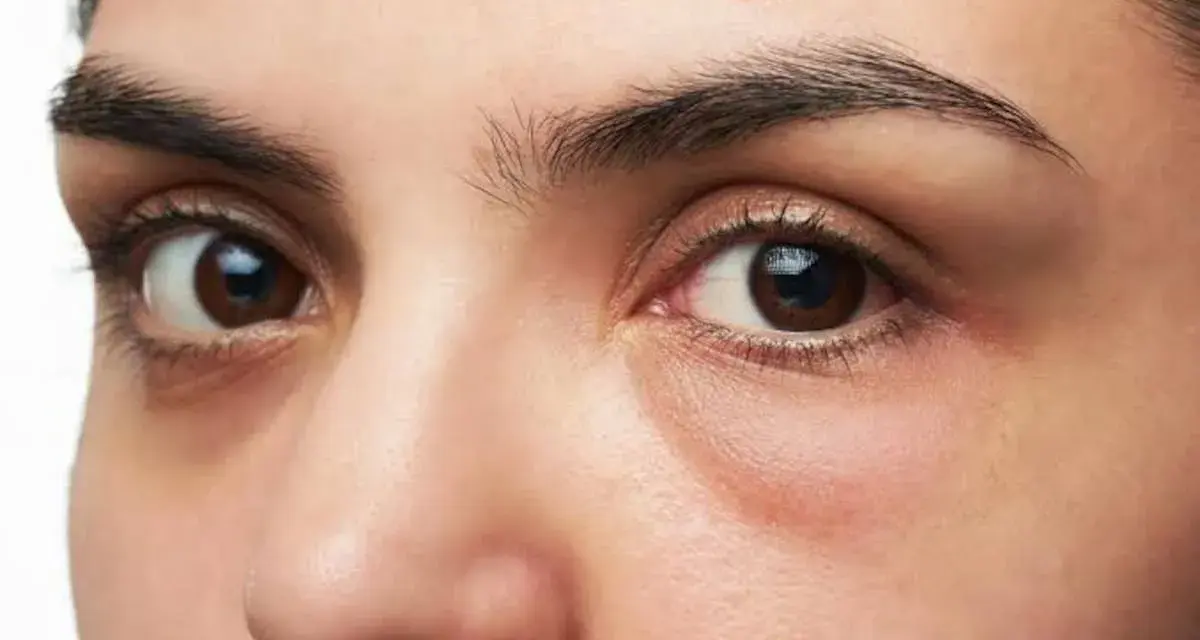 Ojos con ojeras marcadas y una leve hinchazón debajo, sugiriendo una cara hinchada tras una noche de poco descanso.