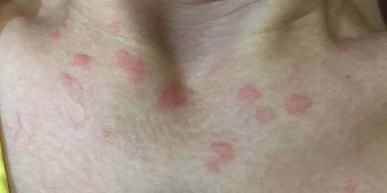 Manchas rojas en el cuello y pecho. ¿Cuándo preocuparse por manchas en la piel? Consulta a un médico si persisten o empeoran.