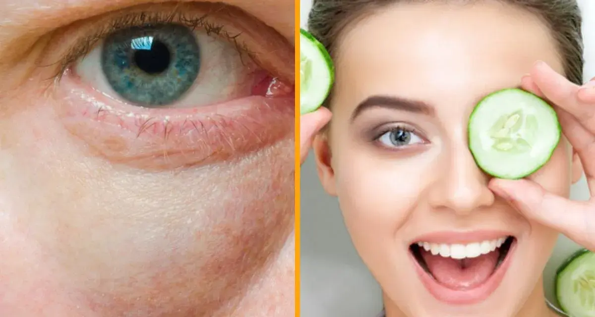 Ojo con bolsas y ojeras, comparado con una mujer sonriente usando rodajas de pepino, un remedio casero para las bolsas en los ojos.