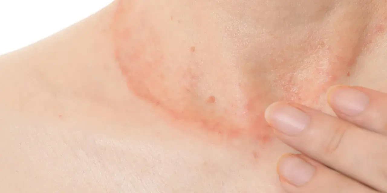 Piel enrojecida y con granos en el cuello, con una mano tocando suavemente la zona afectada.