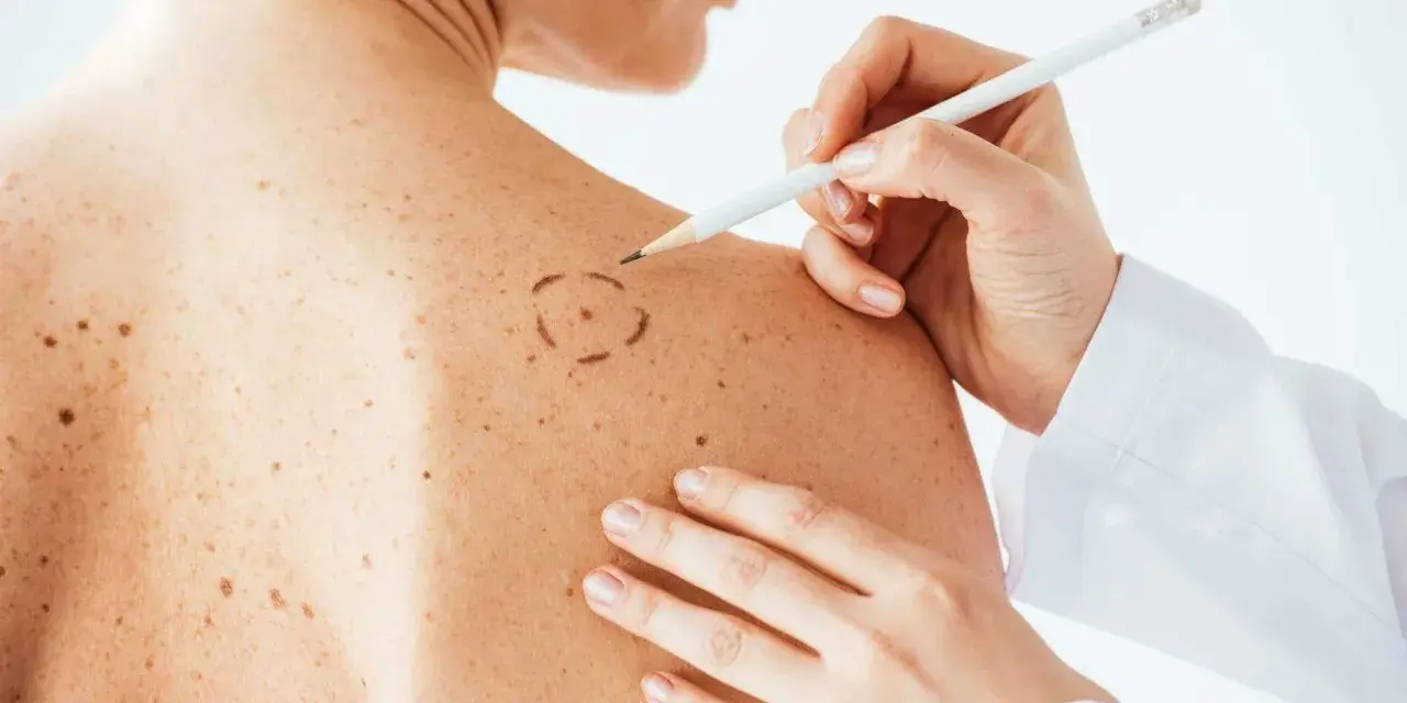 Médico marca con lápiz un lunar en la piel de un paciente. La piel tiene muchos lunares rojos y marrones.