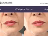 Antes y después de tratar el "código de barras" en los labios. Las arrugas verticales alrededor de la boca se suavizan.