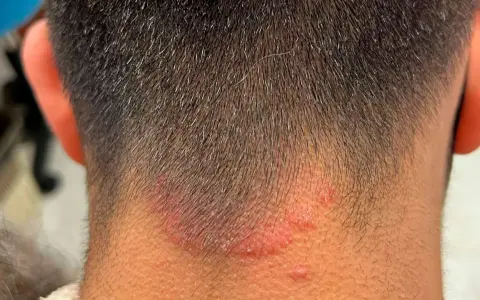 Irritación rojiza y escamosa en la nuca, sugiriendo la presencia de hongos en el cuello.
