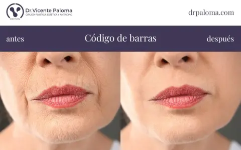 Antes y después de tratar el "código de barras" en los labios. Las arrugas verticales alrededor de la boca se suavizan.