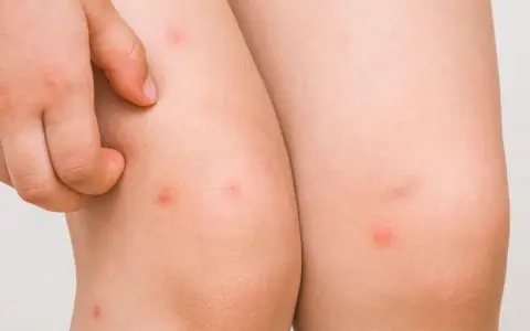 Piel con pequeños bultos rojos, indicativos de foliculitis en las piernas. Un dedo rasca la zona irritada.