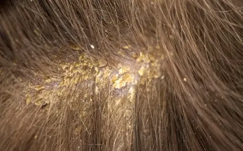 Primer plano del cuero cabelludo con caspa, mostrando escamas amarillentas y una postilla blanca entre el cabello castaño.