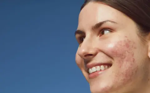 Mujer sonríe con granos entrecejo y mejillas. Piel con acné, fondo azul cielo.