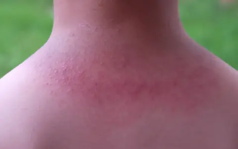 Piel enrojecida con pequeños bultos rojos en el cuello y hombros, indicativo de sarpullido por calor en adultos.