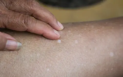 Una mano con un anillo toca la piel, revelando varias manchitas blancas en la piel, algunas más notorias que otras.
