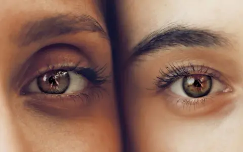Ojos hundidos antes y después. Comparación de dos ojos, uno con ojeras marcadas y otro con piel más lisa y luminosa.