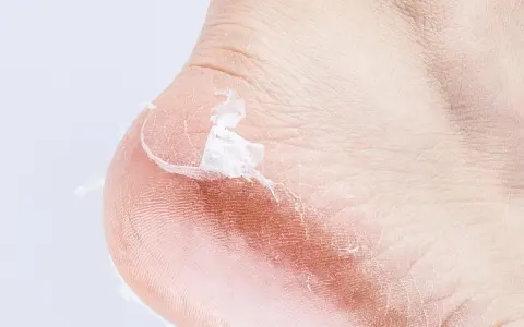 Primer plano de un talón con piel seca y descamada, mostrando por qué se pelan los pies.
