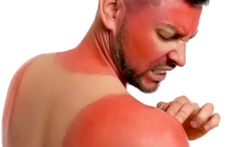 Hombre con quemaduras solares severas en cara y hombros. El vinagre para las quemaduras del sol podría aliviar su dolor.